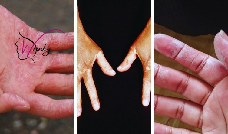 What happens if you get hair bleach on your hands